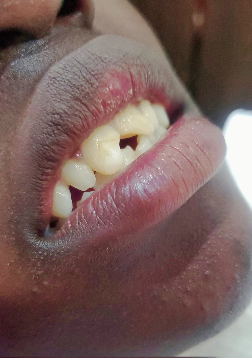 Abledental_Ug's tweet photo. Before/After
#Fronttooth buildup🦷👌 https://t.co/sLpd3GvY5S