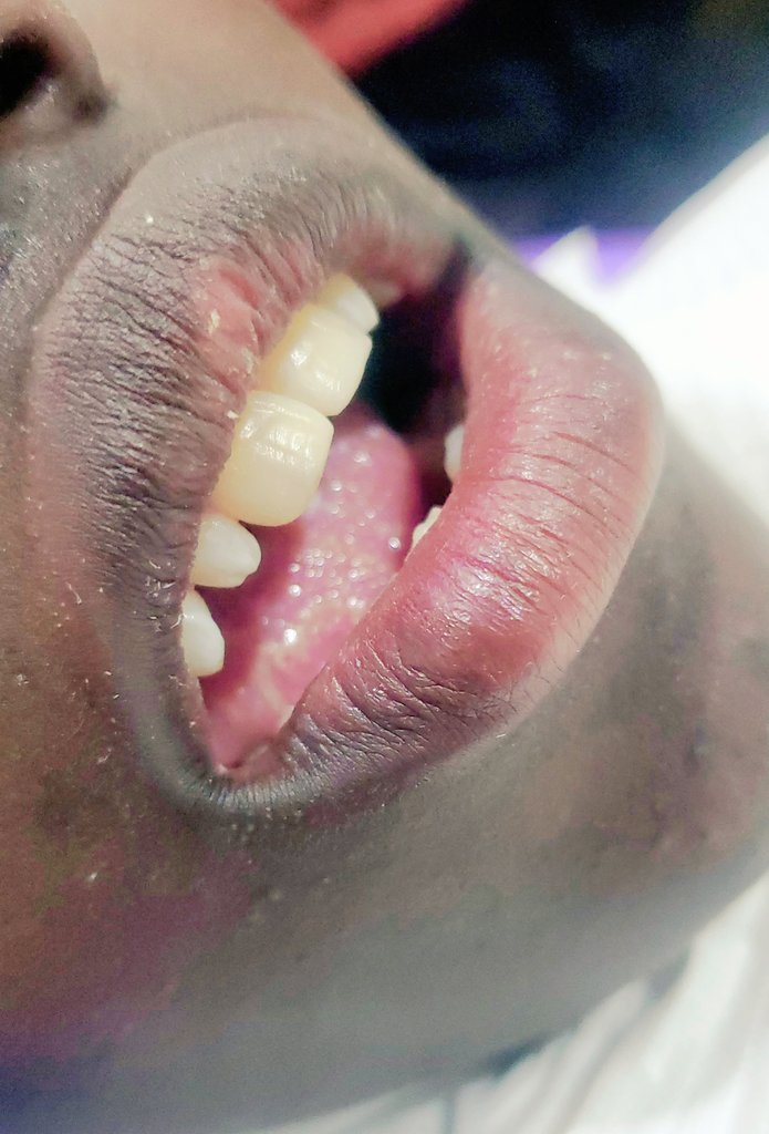 Abledental_Ug's tweet photo. Before/After
#Fronttooth buildup🦷👌 https://t.co/sLpd3GvY5S