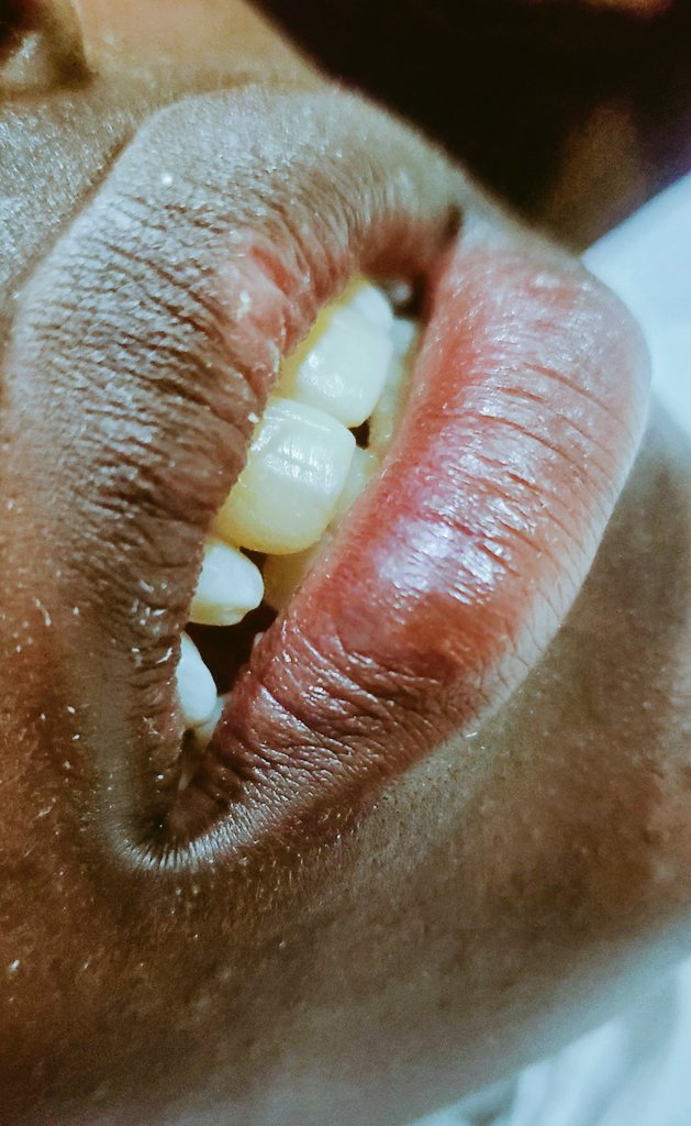 Abledental_Ug's tweet photo. Before/After
#Fronttooth buildup🦷👌 https://t.co/sLpd3GvY5S