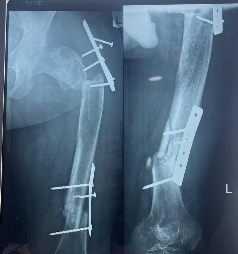 Dr_Yajii's tweet photo. Med Twitter, TBS have started doing ORIF with Plates and screws o. Welcome to Nigeria😂😂😂 where anything is possible. They say come to hospital, you people would say no, sha sha Una go dey alright. https://t.co/3N0uzN6bEP
