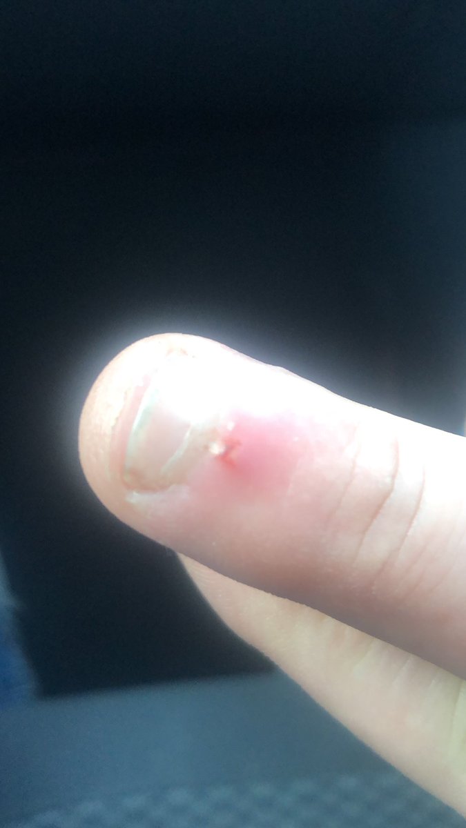 mullett100's tweet photo. The most painful injury know. To mankind #hangnail https://t.co/VLxd9f4JEH