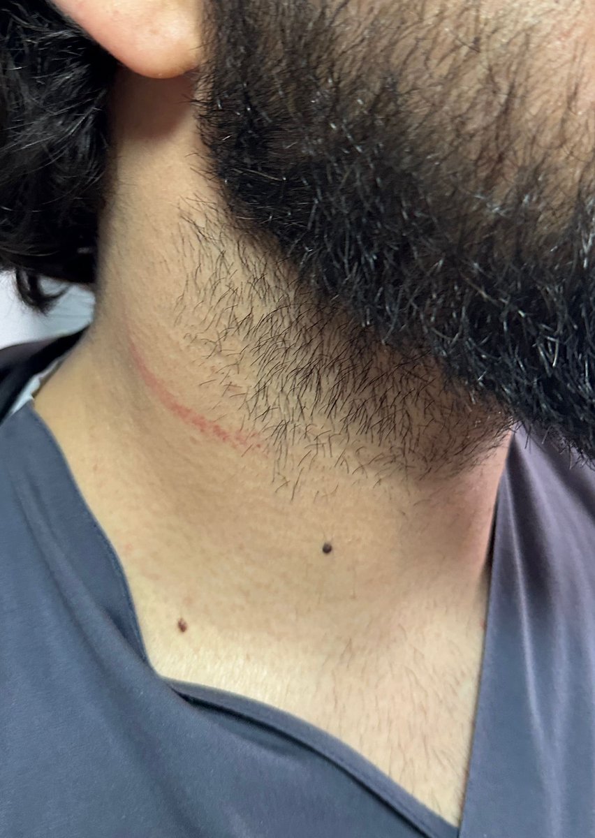 Yer: Sakarya Eğitim Araştırma Hastanesi Çocuk Acil Servis  

Çocuğuna damar yolu açılamadığı ve kolu şiştiği gerekçesiyle acili basıp görevi başındaki meslektaşımı darp etmiş…

#doktordövebiliyoruz