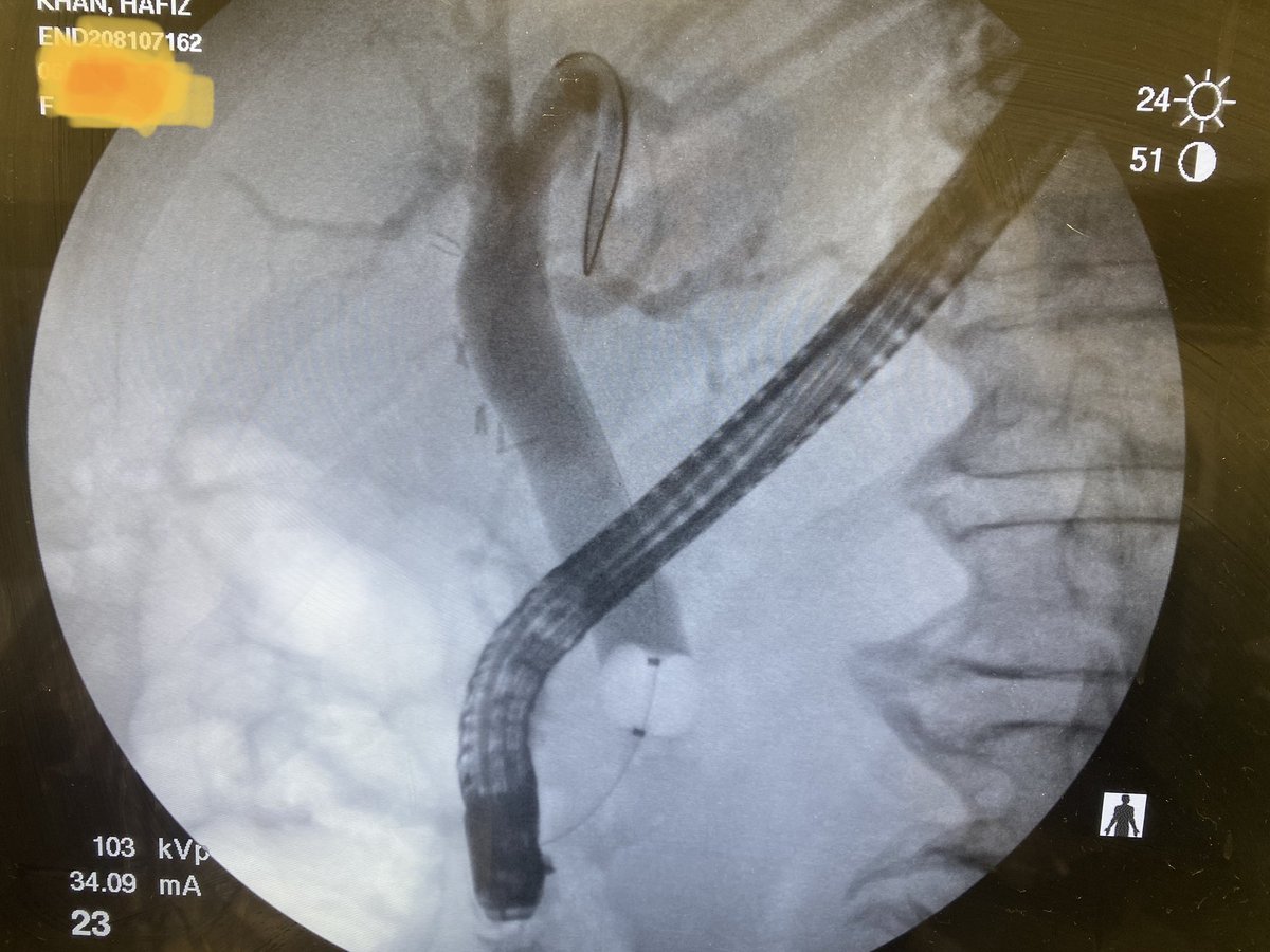 Another Single Session EDGE procedure performed at SUNY Upstate for Acute Ascending Cholangitis and Klebsiella Bacteremia.