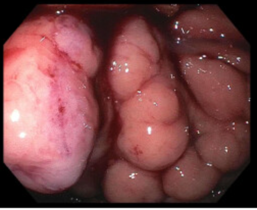 😮Recent 🩸 gastric varices‼️
‼️ Not a candidate for TIPS and failed BRTO
#OSUGHNDIVISION #OSUAdvEndo You gotta problem, we'll solve it. Check out the coils, while the endoscopist resolves it #coilscoilsbaby