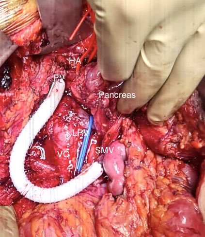 jorgecardenas29's tweet photo. Pancreatectomía radical cefálica con reconstrucción del eje mesentérico porta tipo 4 del #ISGPS por infiltración tumoral secundario a adenocarcinoma de páncreas irresecable posterior 4 x #FOLFOX con shunt porto-mesentérico #TodosVsElCáncer @IHPBA @EAHPBA @SMEOMX @Cirbosque https://t.co/xog7c5Bkn6