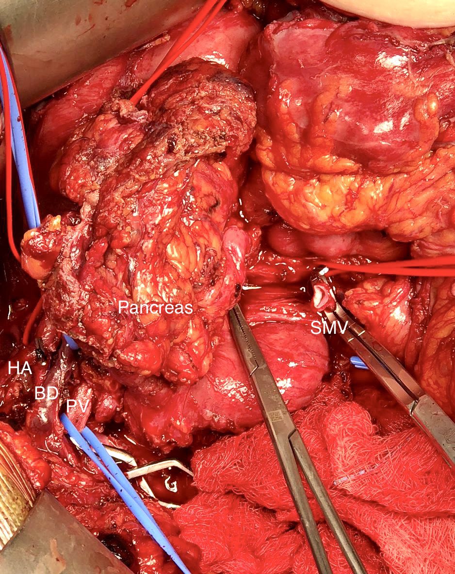 jorgecardenas29's tweet photo. Pancreatectomía radical cefálica con reconstrucción del eje mesentérico porta tipo 4 del #ISGPS por infiltración tumoral secundario a adenocarcinoma de páncreas irresecable posterior 4 x #FOLFOX con shunt porto-mesentérico #TodosVsElCáncer @IHPBA @EAHPBA @SMEOMX @Cirbosque https://t.co/xog7c5Bkn6