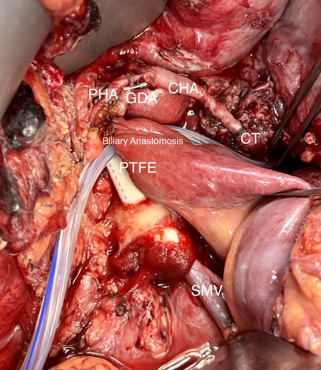 jorgecardenas29's tweet photo. Pancreatectomía radical cefálica con reconstrucción del eje mesentérico porta tipo 4 del #ISGPS por infiltración tumoral secundario a adenocarcinoma de páncreas irresecable posterior 4 x #FOLFOX con shunt porto-mesentérico #TodosVsElCáncer @IHPBA @EAHPBA @SMEOMX @Cirbosque https://t.co/xog7c5Bkn6