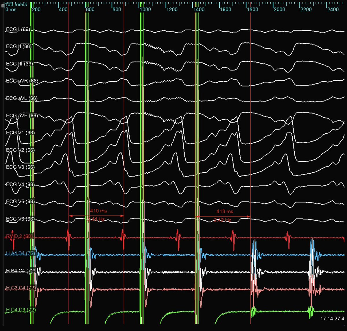 Ever tried to #ablateVT in pt with LVAD and been stuck with ECG on left?  Low pass filter on ECG  &lt;20Hz  removes the noise.  EAM systems have very different filtering options, some don't allow &lt;100Hz.  Nice case with concealed entrainment with clean ECG on #EnsiteX. #Epeeps