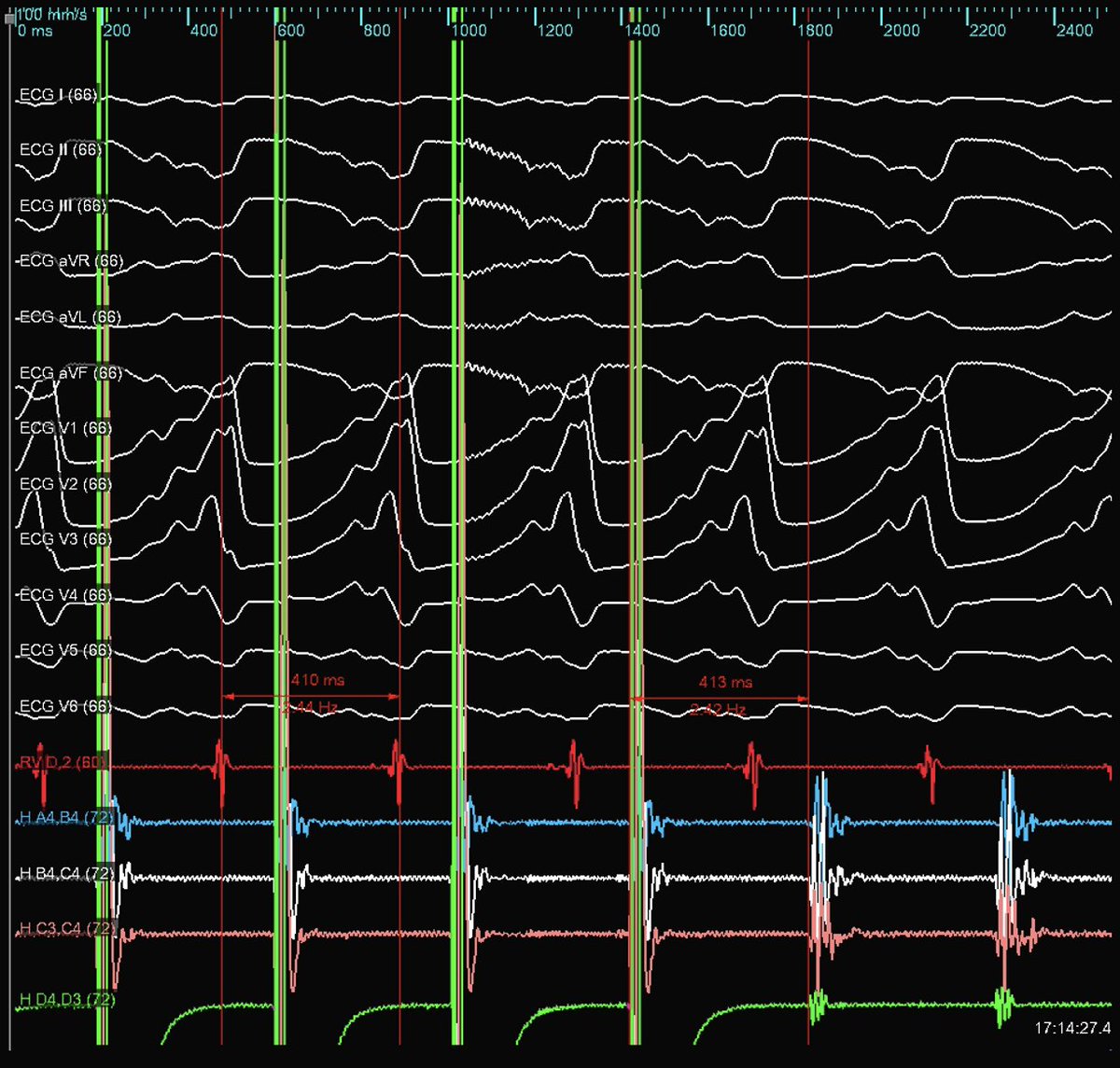 Ever tried to #ablateVT in pt with LVAD and been stuck with ECG on left?  Low pass filter on ECG  <20Hz  removes the noise.  EAM systems have very different filtering options, some don't allow <100Hz.  Nice case with concealed entrainment with clean ECG on #EnsiteX. #Epeeps