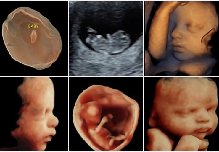 The4DLady's tweet photo. The mission of this page is to share as many ultrasound images of babies as possible to show the inescapable truth that life in the womb is obvious and should be protected. Every image posted is 100% authentic and taken by an OBGYN registered sonographer on E8/E10 machines https://t.co/D6UsfrHlNh