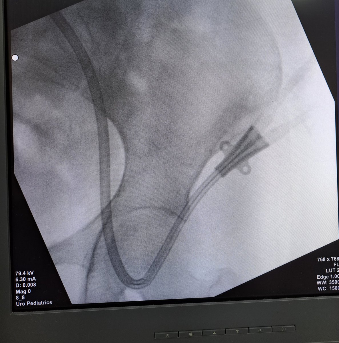Post-trombolisis con tenecteplase, se rescató acceso femoral valioso colocándose acceso tunelizado femoral con tunel subcutáneo abdominal. <a href="/ForceNeph/">Juan Carlos Flores 🇲🇽 M.D. FISN</a> también en Veracruz hay con queso...