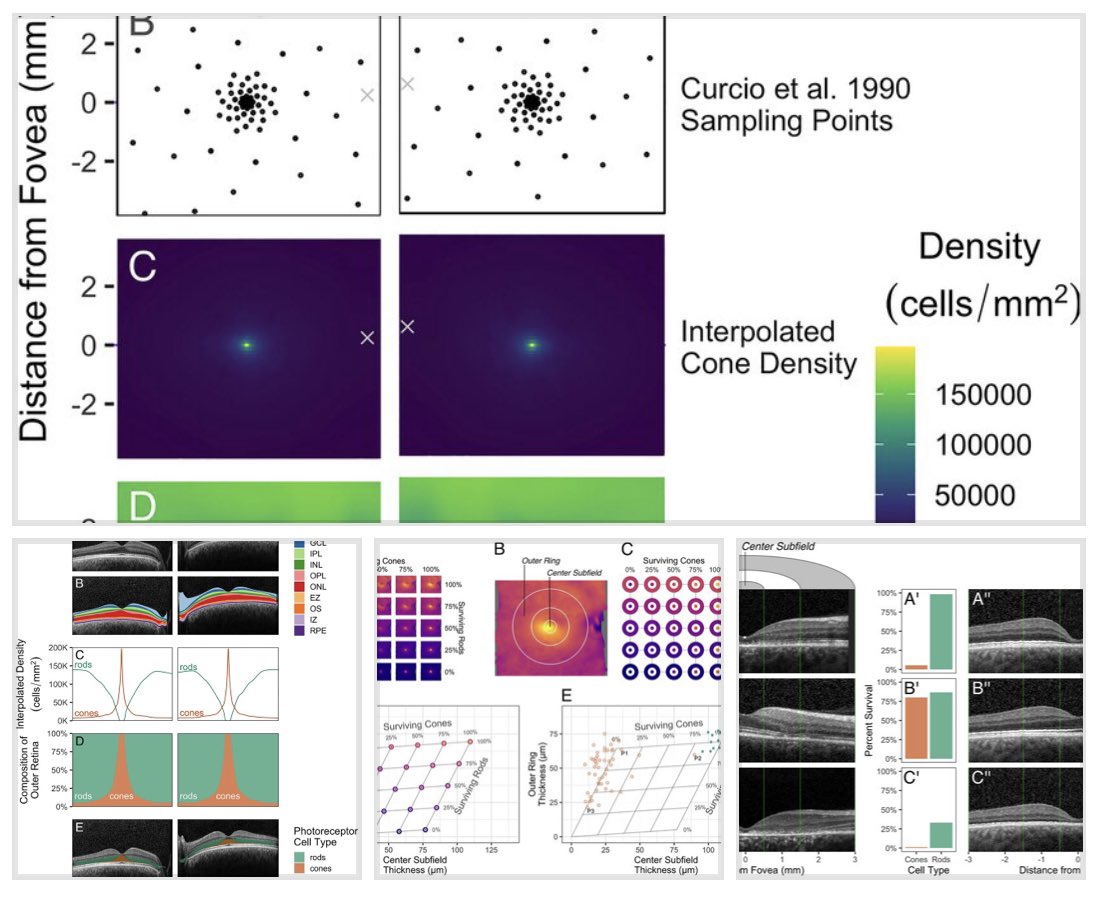 Ian Han, MD (@3y3md) on Twitter photo Thanks to open source data from Christine Curcio’s (<a href="/AMD_histo_lab/">Christine A. Curcio PhD</a>) landmark 1990 photoreceptor topography paper…
We can use modern computational methods to model #retina cell loss by OCT.
nature.com/articles/s4159… 👀
Beautiful work by the brilliant <a href="/sswhitmore/">S. Scott Whitmore</a> + RIM Lab team! Thanks to open source data from Christine Curcio’s (<a href="/AMD_histo_lab/">Christine A. Curcio PhD</a>) landmark 1990 photoreceptor topography paper…
We can use modern computational methods to model #retina cell loss by OCT.
nature.com/articles/s4159… 👀
Beautiful work by the brilliant <a href="/sswhitmore/">S. Scott Whitmore</a> + RIM Lab team!