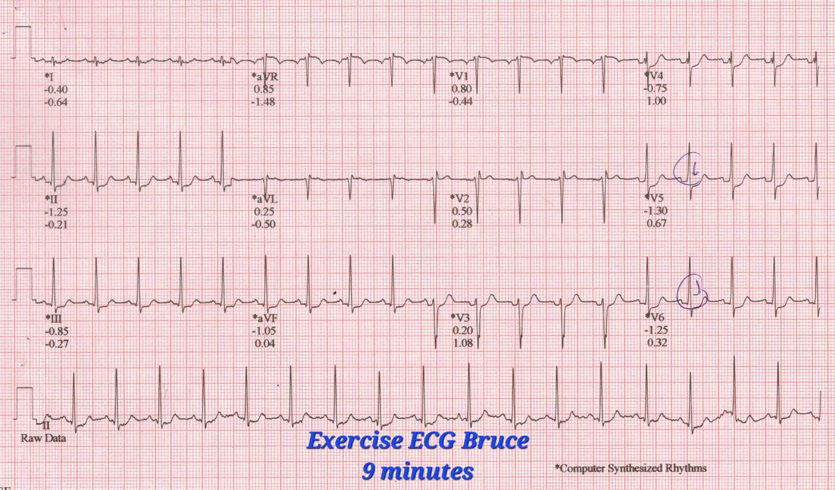 GopalKkoduru's tweet photo. 44♂️, anterior MI, #PCI #BMS 2.5X23 at 8 atms 6/2007, when he was 28, #Instentrestenosis in 09/2027, re PCI Cypher 2.5X23, 2.5x33. No FH/modifiable risk factors, LDL 45 on statins. No cardiac events since then. Walks regularly, no angina. Routine check up. TMT +ve, Bruce, 9 mins. https://t.co/cGsweoNEl3