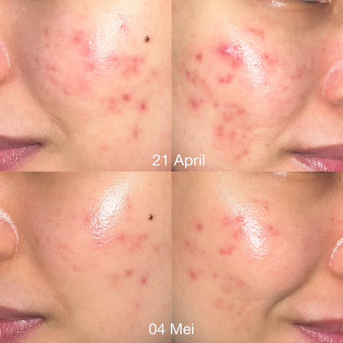 Heyywidi's tweet photo. Ini kondisi muka ku tanggal 21 April dan 04 Mei. Keliatan banget perubahannya. Aku sempat konsul ke dokter SpKK di Halodoc. Terus dikasih saran pake basic skincare: facial wash, moisturizer, sunscreen dan obat minum https://t.co/IFQvex6iBW