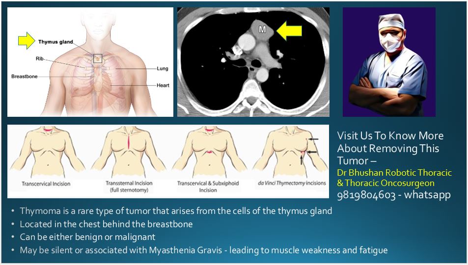 dr_thoracic's tweet photo. #healthtourismIndia #thymectomy #thymus #surgery #myastheniagravis https://t.co/rsaF3oCV0A