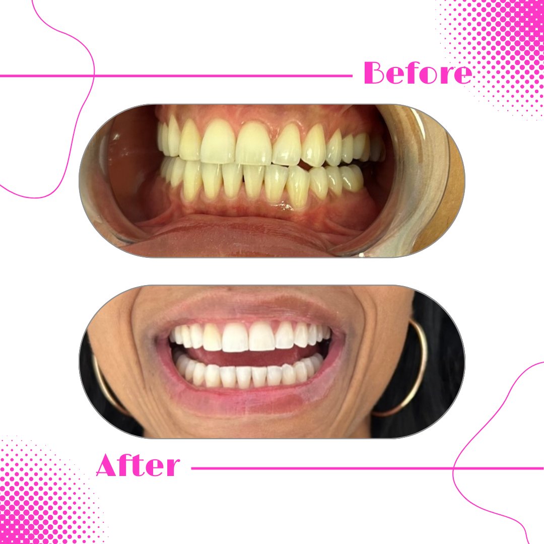 IssaRissa11's tweet photo. Oh and I whiten teeth now too. K bye 🦷🫶🏽 https://t.co/boDmWUpPqx