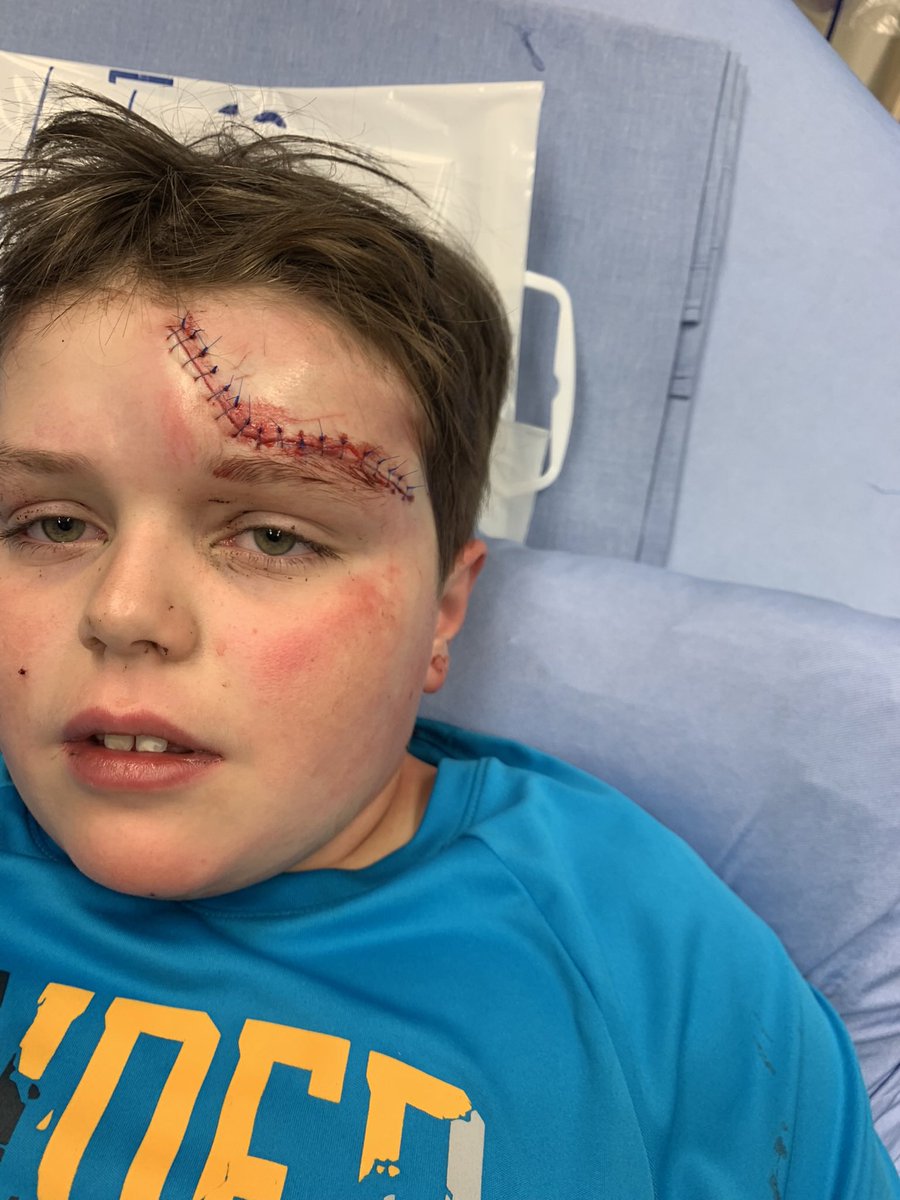 Since everyone’s kids are out and about riding machines with the warm weather, this happened to my son in April 2022. He was wearing a helmet and if he wasn’t, he likely isn’t here with us.  This is a reminder to all that accidents happen everyday…please remind your kids be safe