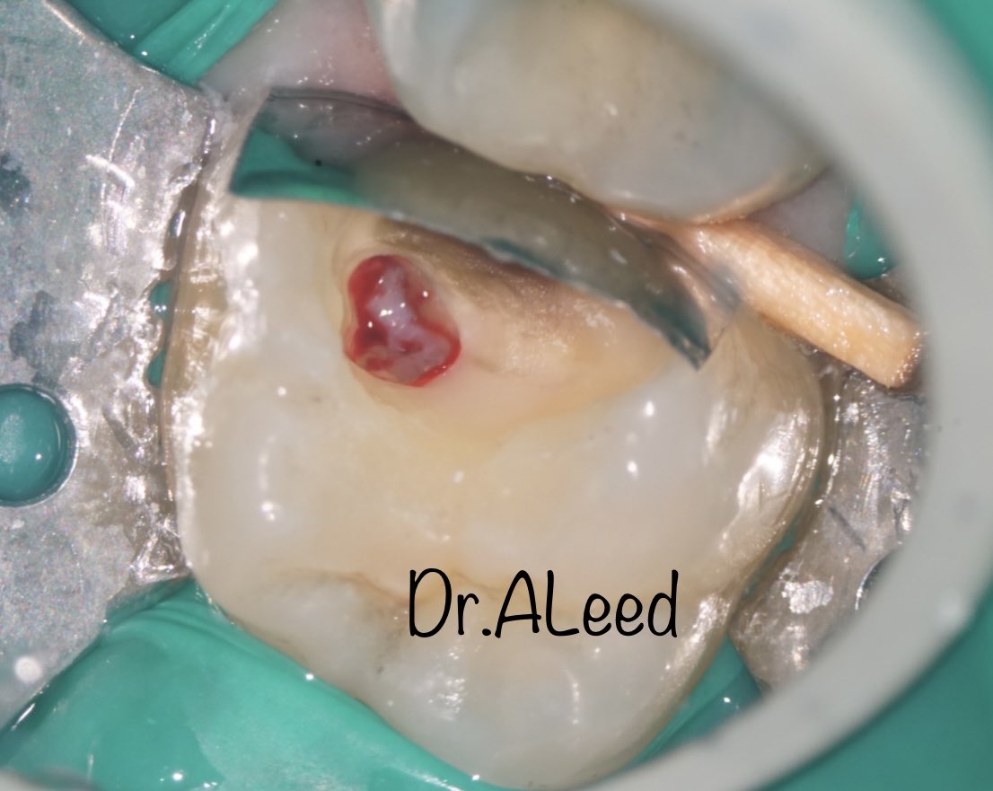 Partial pulpotomy with one year follow up 

To be a good Endodontist, you should know how to save the pulp, not only remove it.