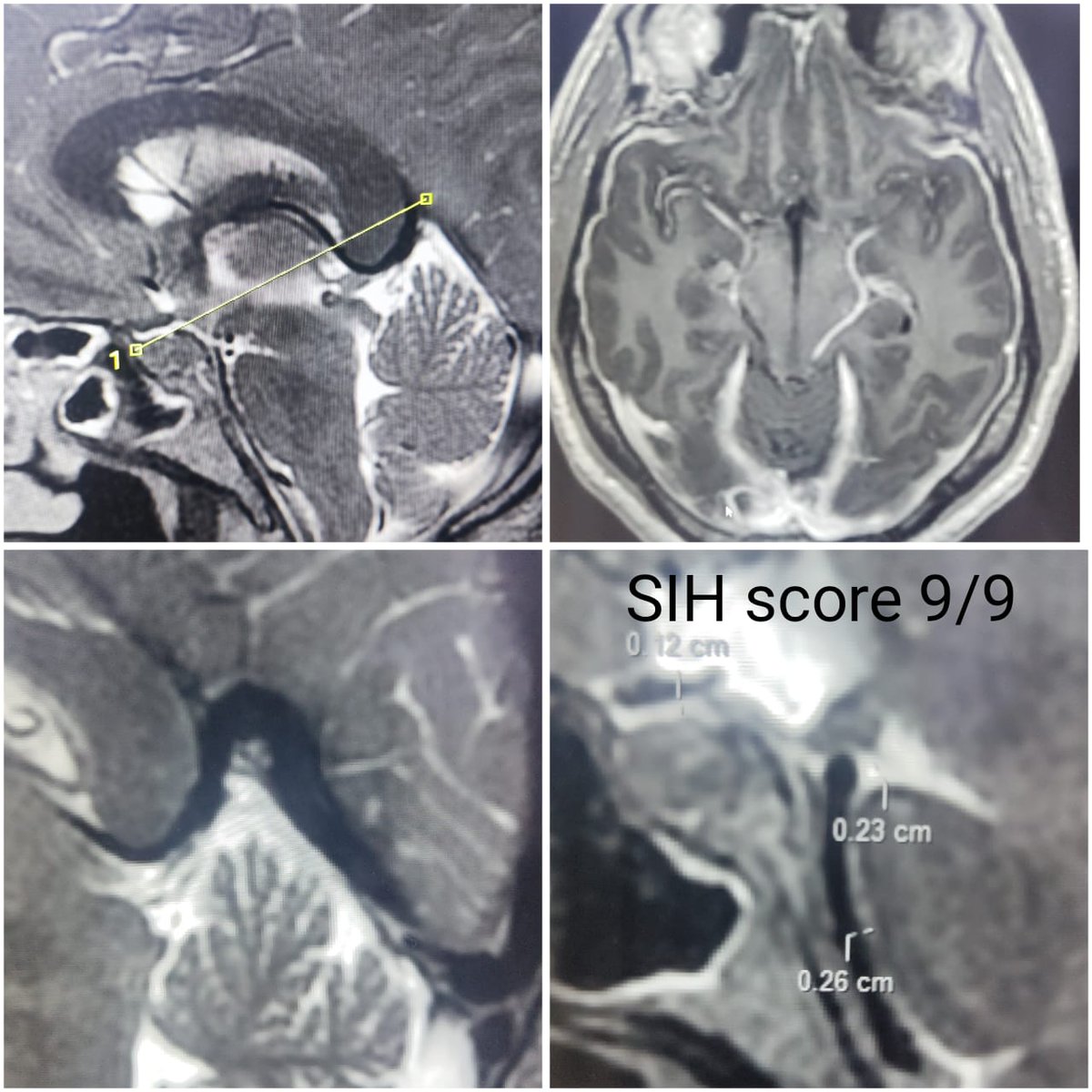 SharathKumarGG7's tweet image. Symptomatic Type 1A spinal CSF leak due to bony spur. SIH score 9/9, treated with EBP and hopefully it will offer some long term benefits! #sih #SpinalCSFleak #headache #EBP @spinalCSFleak @The_ASSR @SpinalCSFCanada @CarolinaIten