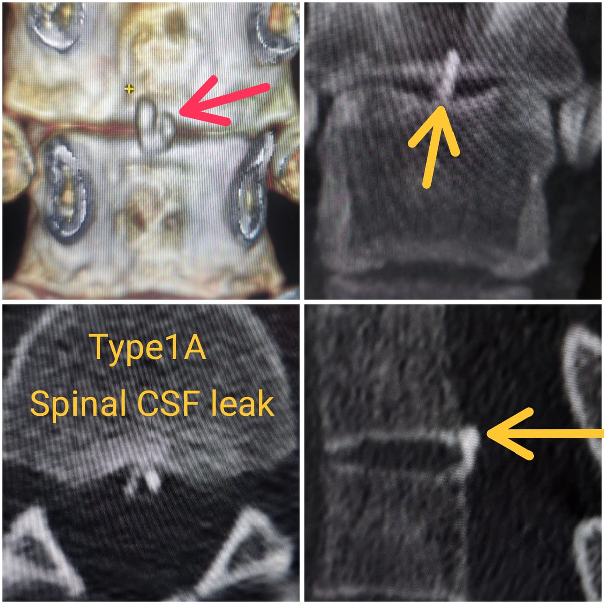 SharathKumarGG7's tweet image. Symptomatic Type 1A spinal CSF leak due to bony spur. SIH score 9/9, treated with EBP and hopefully it will offer some long term benefits! #sih #SpinalCSFleak #headache #EBP @spinalCSFleak @The_ASSR @SpinalCSFCanada @CarolinaIten