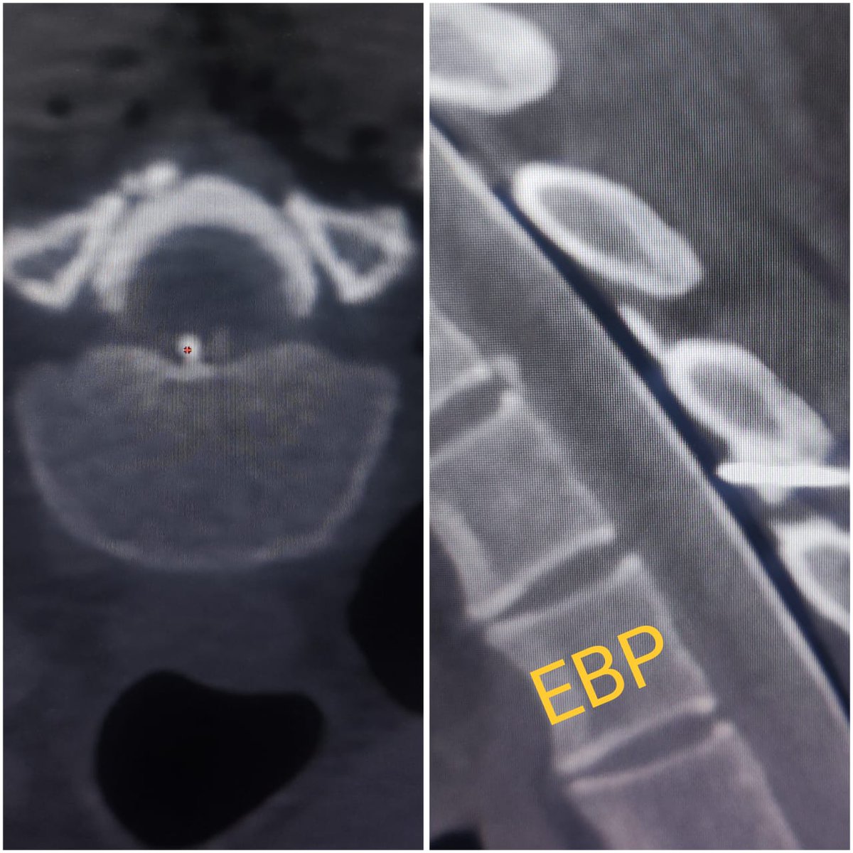 SharathKumarGG7's tweet image. Symptomatic Type 1A spinal CSF leak due to bony spur. SIH score 9/9, treated with EBP and hopefully it will offer some long term benefits! #sih #SpinalCSFleak #headache #EBP @spinalCSFleak @The_ASSR @SpinalCSFCanada @CarolinaIten