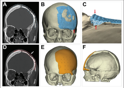 IJB_ASP's tweet photo. Welcome to read this article from International journal of #bioprinting. 🤗
Additively manufactured #polyether ether #ketone (PEEK) #skull implant as an alternative to #titanium mesh in #cranioplasty
Please see more details at: 👇👇https://t.co/vUAWDnqjrf https://t.co/i1gLDtns3r