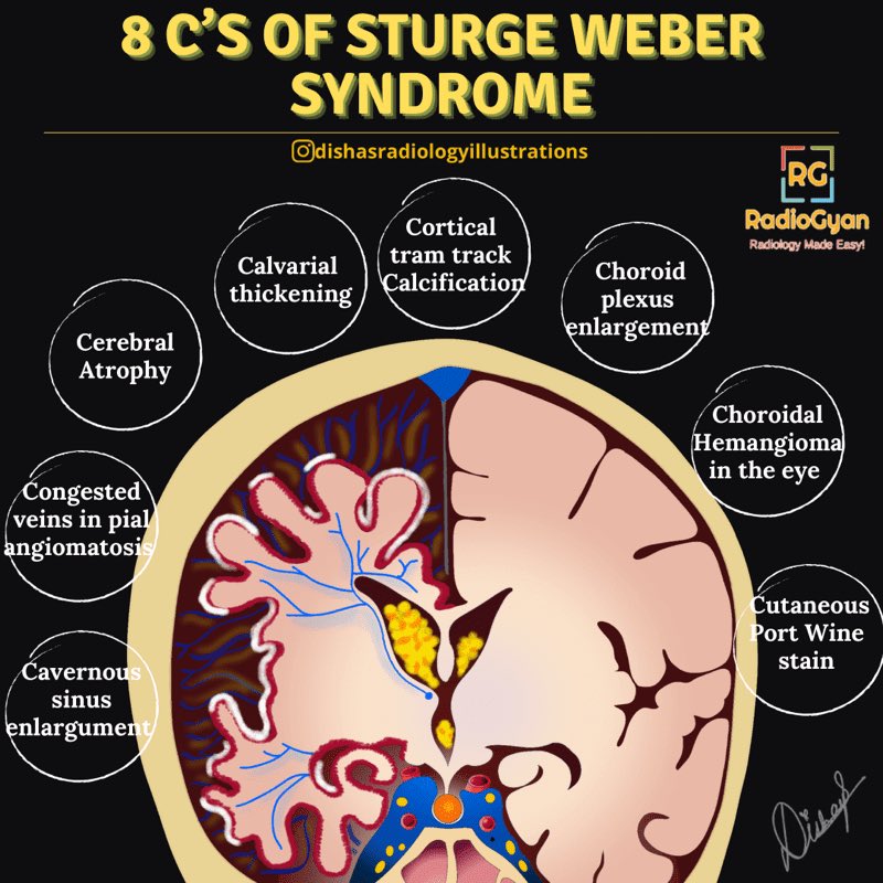 Raja25149238887's tweet photo. DD
-multiple intracranial calcifications -cerebral hemiatrophy
-leptomeningeal enhancement
#cerebral arteriovenous malformation (AVM)
#infection
TORCH infection
neurocysticercosis
#PHACE syndrome
#healed cortical infarct
#radiotherapy
#Gobbi syndrome https://t.co/Ig0dcdpbqy