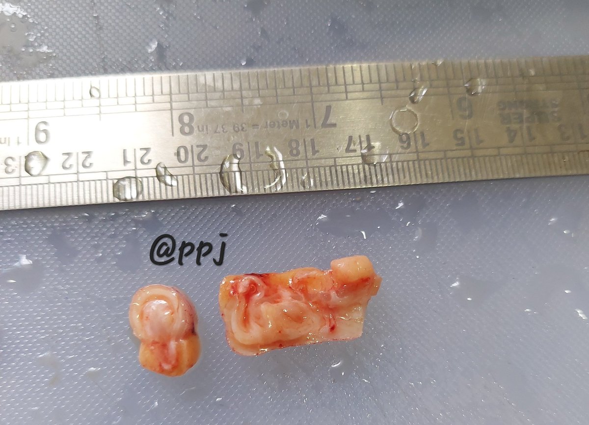 padmapathology1's tweet photo. Diverticulosis of appendix
#PathTwitter #GIpath 
#NotSoBoringAppendix 
✳️ Uncommon
✳️Majority - acquired pseudodiverticulae
✳️a/w obstructing or incidental appendiceal neoplasms
✳️Suspect- adult ♂️ with chr abdominal pain
🔬 Herniation of mucosa and muscularis mucosa through wall https://t.co/hugyeO7s74