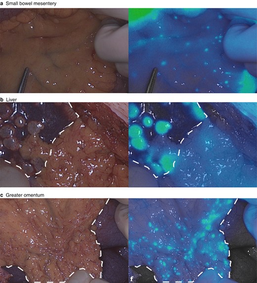 BJSurgery's tweet photo. OA in May's BJS: Fluorescence-guided surgery using methylene blue to improve identification of metastatic small intestinal neuroendocrine tumours https://t.co/W3lQY7X4fl @bplwijn @des_winter @ksoreide @MalinASund @evanscolorectal @nfmkok @paulo_sutt @robhinchliffe1 @young_bjs https://t.co/DNkt9eG5mU