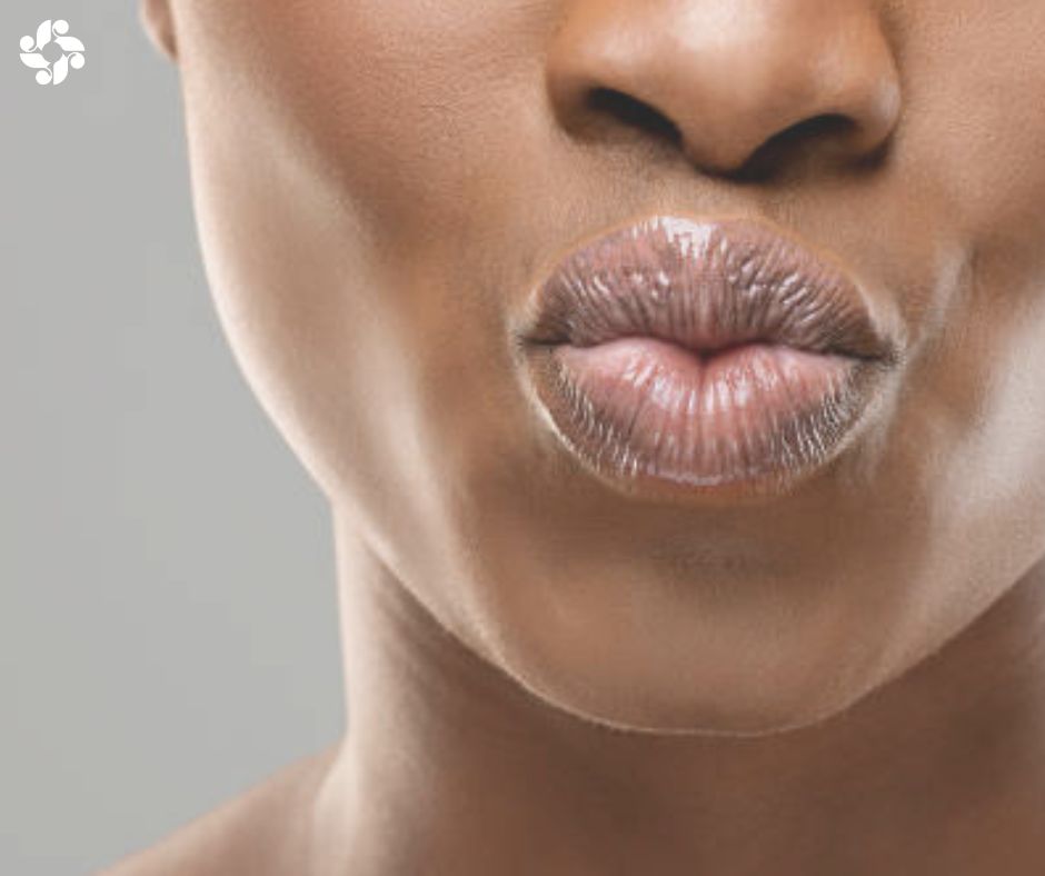 SkinBodyRenewal's tweet photo. Loss of lip volume is a common sign of ageing, as the skin & underlying tissues thin out over time. The sooner you start with soft tissue rejuvenation, the better. Early-developing lip wrinkles are much easier to treat https://t.co/a5KY8CqQF2 #SkinRenewalSA #lipvolume #ageinglips https://t.co/E09byMPiK9