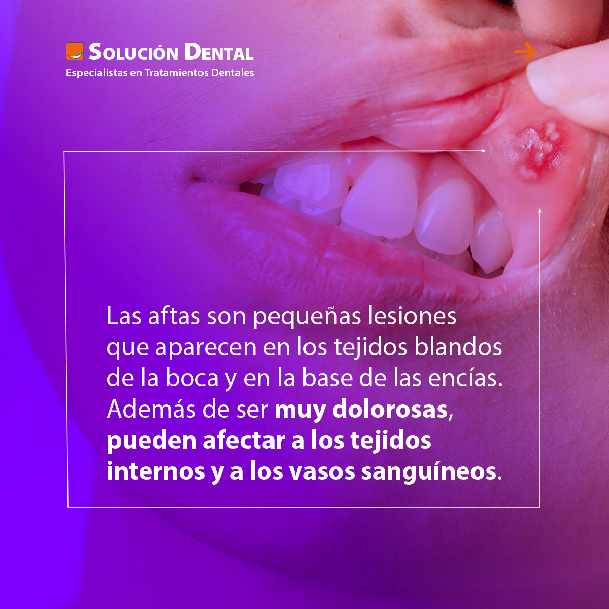 SolucionDentalE's tweet photo. ¿Tienes aftas? Son lesiones muy dolorosas que precisan se tratadas. Hoy te contamos qué son las aftas, las causas de su aparición y su tratamiento. @CFMadridRio #aftas #cuidatusonrisa #clinicadental #dentistas #estres #alergias https://t.co/FEflOgX6qJ
