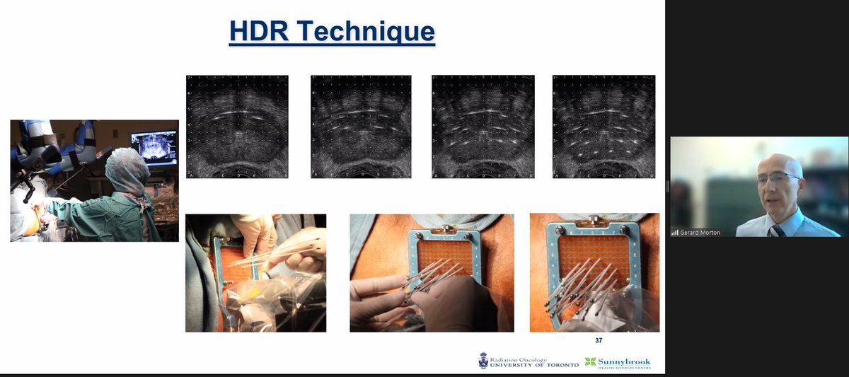 HDR brachytherapy as monotherapy: