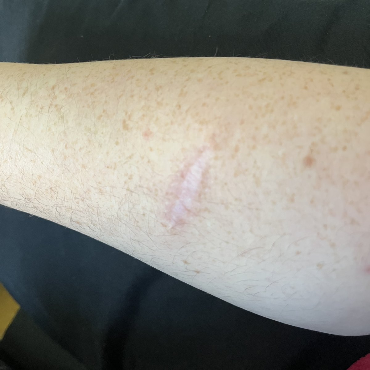 I’ve been using Scar Erase for a bit now, and I’m so happy with the improvement I’ve seen on my arm scar from a lump removal back in 2021! 

It’s visibly become flatter, lighter and more skin-toned over time, and notably less visible! |AD