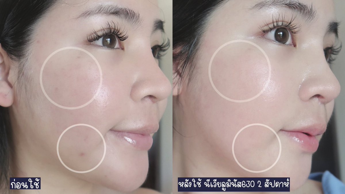 ยืนหนึ่งลดฝ้ากระจุดด่างดำแบบเห็นผลจริง ใน 2 สัปดาห์  NIVEA Luminous630 เห็นรีวิวมานาน พอได้ลองเองคือชอบมากก  ผิวกระจ่างใสขึ้น ด้วยสารลูมินัส 630 ที่เป็นสารลดจุดด่างดำที่ดีที่สุดตอนนี้เลย เมื่อเทียบกับสารไบรท์เทนนิ่งอื่นๆ ใช้ครบเซ็ตยิ่งเห็นผลไว 2 เท่า ใช้ดีทุกตัว