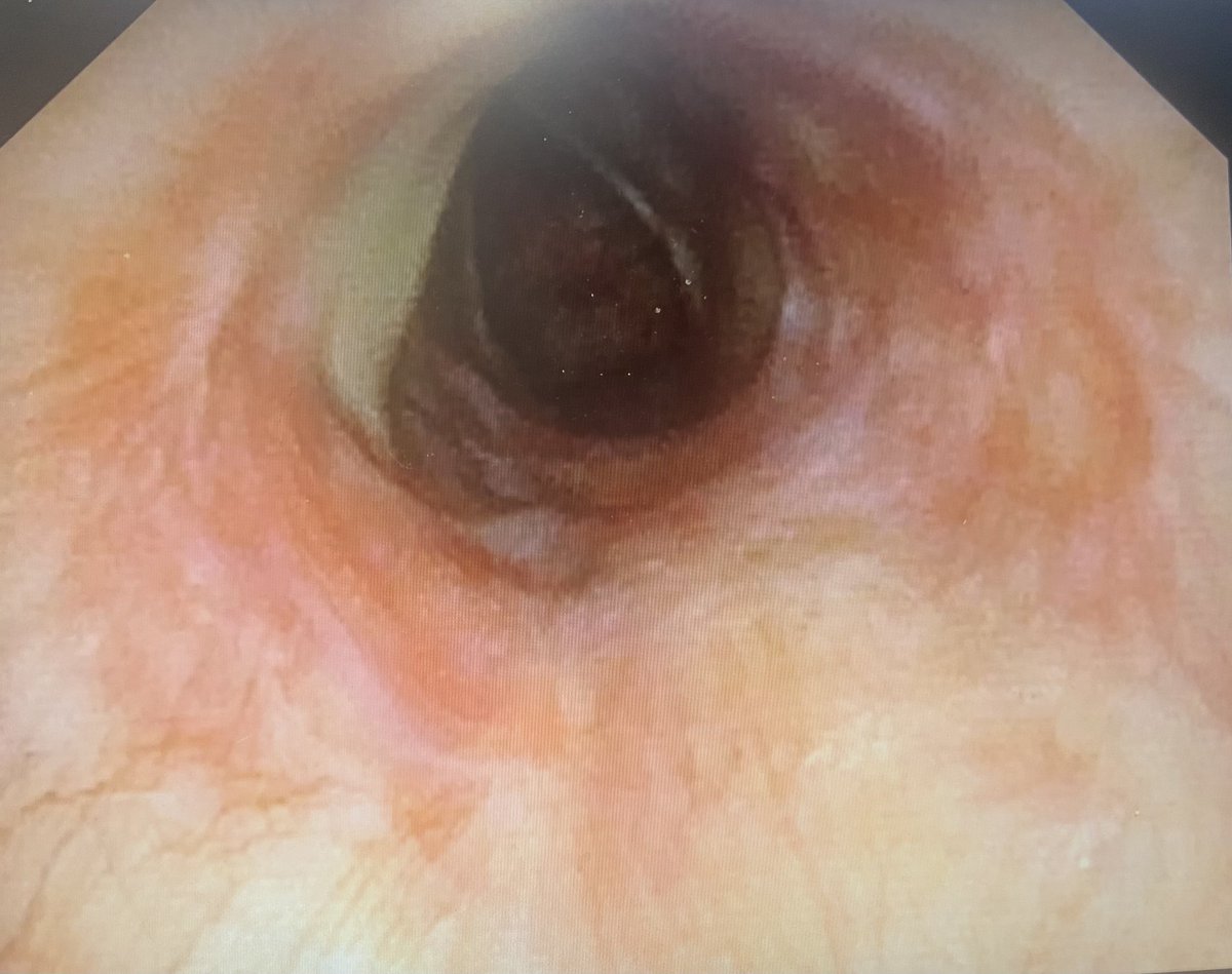 juanjocruzrueda's tweet photo. 🫁Estenosis traqueal tratada en el @TorrecardenasHU 

🔪Cortes radiales con endocut argón 
🎈Dilatación progresiva con balón
 💉Instalación de trigon depot 

🔄Revisión por traqueostomia 3 dias tras intervencion (dti) y 18 dti

Cierre🎯🩹

Neumo Int🩻🩺💪 https://t.co/mM3zgjyby8