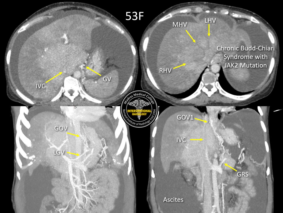 iRadBIR_Chennai's tweet photo. Failed endovenous portal vein puncture for #DIPSS even after multiple attempts (struggled for hours😫). Our chief scrubbed in and did "Percutaneous Gunsight technique🎯". Successfully deployed the stent and established Portocaval shunt. #iRad #TwittIR #MedTwitter #DIPSSforBCS https://t.co/xjfDfv10KG