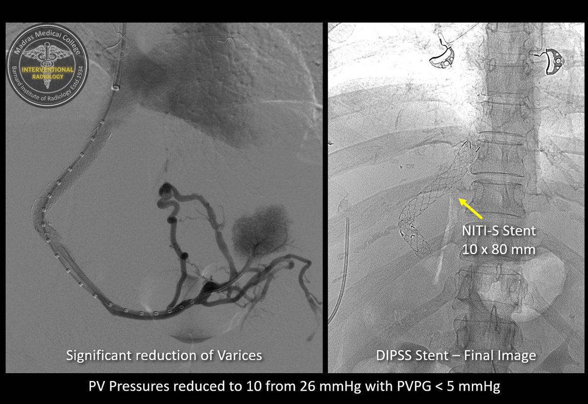 iRadBIR_Chennai's tweet photo. Failed endovenous portal vein puncture for #DIPSS even after multiple attempts (struggled for hours😫). Our chief scrubbed in and did "Percutaneous Gunsight technique🎯". Successfully deployed the stent and established Portocaval shunt. #iRad #TwittIR #MedTwitter #DIPSSforBCS https://t.co/xjfDfv10KG
