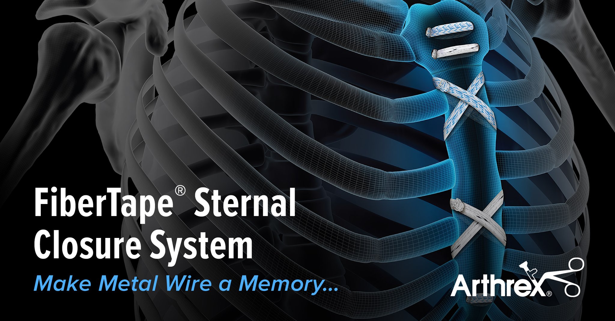 Arthrex MedEd on Twitter "The Arthrex FiberTape® sternal closure system is a 100 nonmetallic