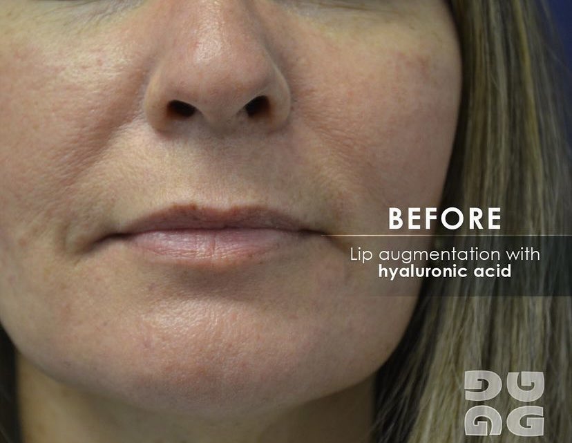 DrGottenger's tweet photo. Lip augmentation with hyaluronic acid for natural look 👄💋

Appointment Only
Call Us Now (305) 669-0900

#beforeandafter #plasticsurgerymiami #plasticsurgerybeforea ndafter https://t.co/LP48EXT5cx