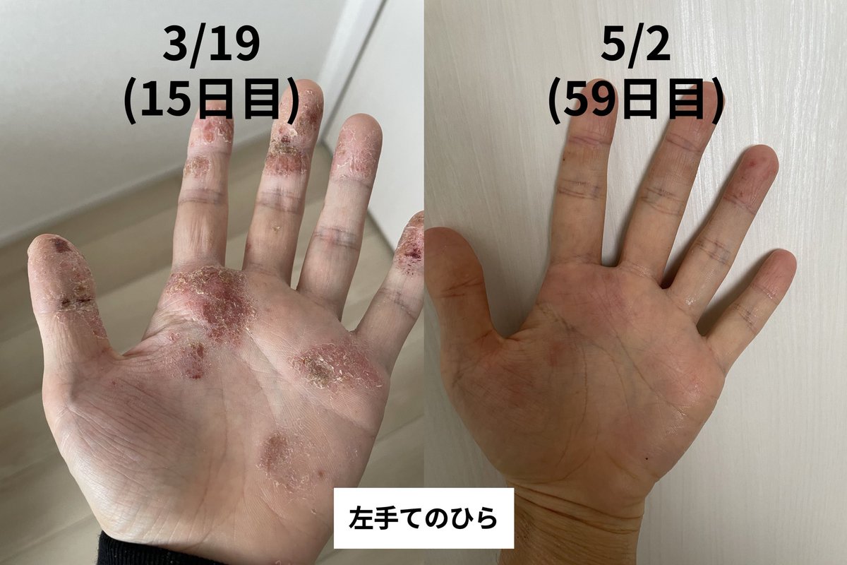 hiroppuuu's tweet photo. この2ヶ月間でずいぶん良くなった！このまま全身も顔も良くなっていってほしい
#脱ステ #脱保湿 https://t.co/97ItzyjVOp