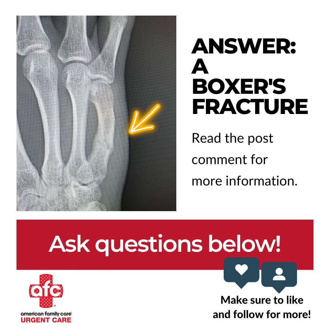 This is a boxer fracture! Typically, these types of fractures accompany a history of punching, followed by pain of the ulnar side of the wrist over the 5th metatarsal (hand bone between the pinky finger and wrist bone). Usually, we see boxer fractures... afcurgentcare.com/cheltenham/
