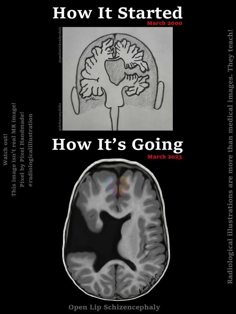 How It Started vs How It’s Going 

#howitstartedvshowitsgoing 

#radiologicalillustration ✍️