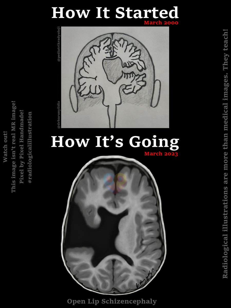 drharunyildiz's tweet image. How It Started vs How It’s Going 

#howitstartedvshowitsgoing 

#radiologicalillustration ✍️