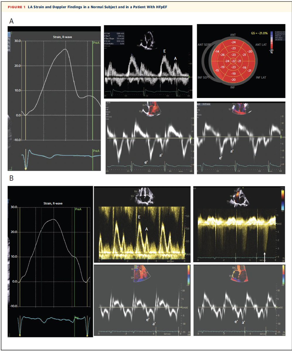 Emanuele Monda (@mondaemanuele) on Twitter photo Left Atrial Strain for Assessment of Left Ventricular Diastolic Function Focus on Populations With Normal LVEF
<a href="/JACCJournals/">JACC Journals</a>
jacc.org/doi/10.1016/j.… Left Atrial Strain for Assessment of Left Ventricular Diastolic Function Focus on Populations With Normal LVEF
<a href="/JACCJournals/">JACC Journals</a>
jacc.org/doi/10.1016/j.…
