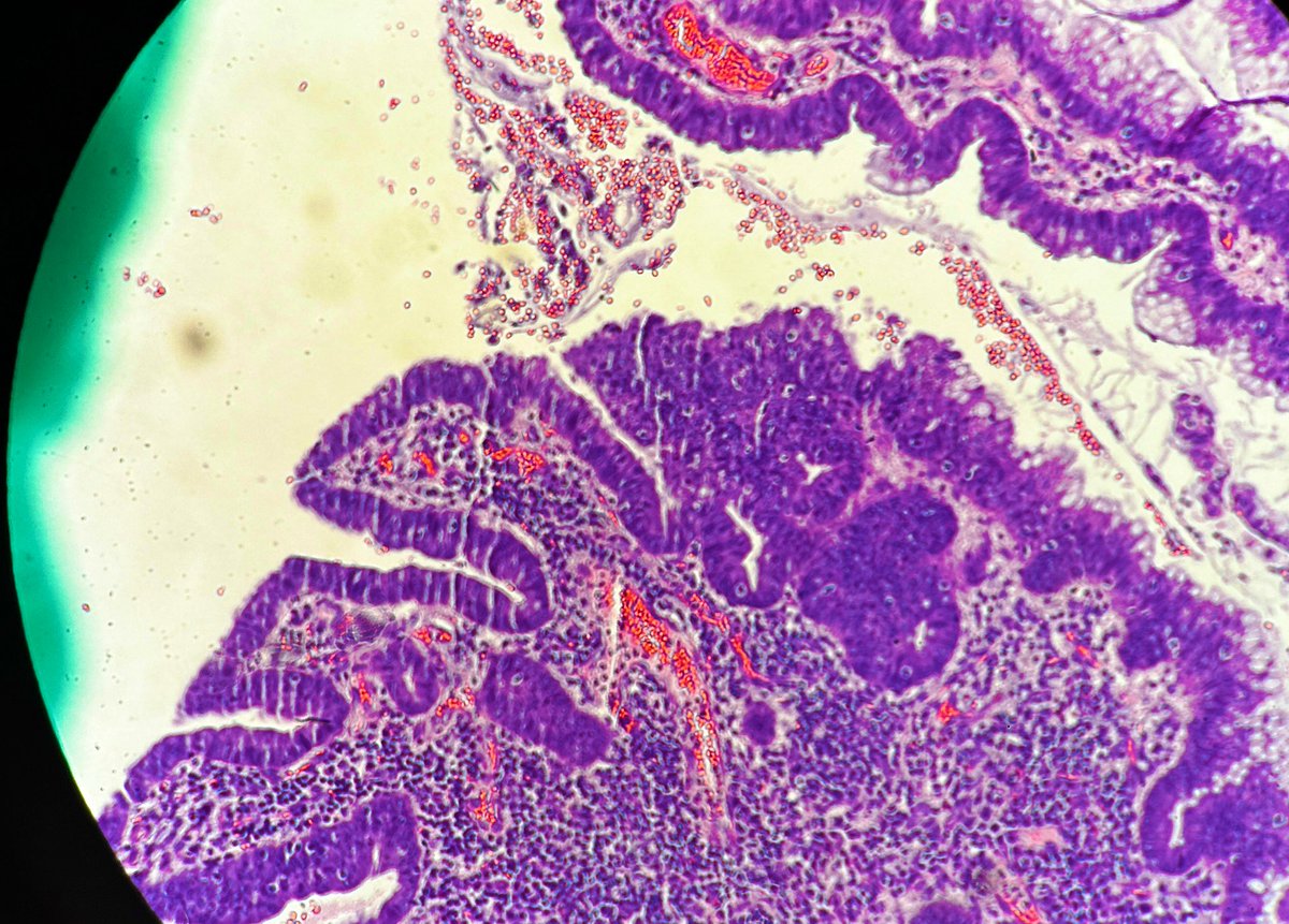Path4People's tweet photo. FriYAY! ๐๐ฅณ
This #casestudyfriday features a routine colonoscopy of a 60-year-old woman where a 1.5 cm polyp was found. Her mom had colon cancer at 72.
#path4people
Answer: https://t.co/qzAMp5LXFL https://t.co/eZOqTQqRmj