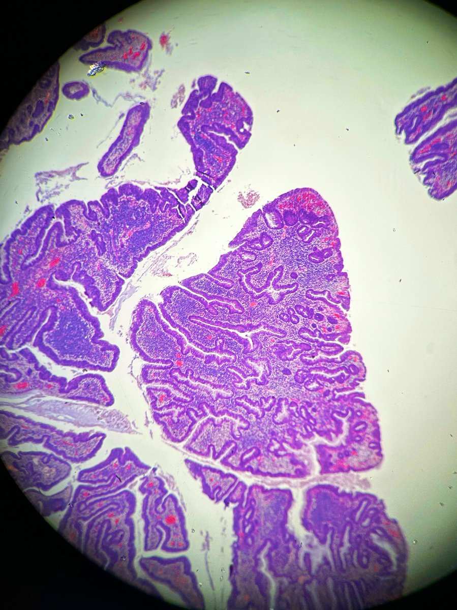 Path4People's tweet photo. FriYAY! ๐๐ฅณ
This #casestudyfriday features a routine colonoscopy of a 60-year-old woman where a 1.5 cm polyp was found. Her mom had colon cancer at 72.
#path4people
Answer: https://t.co/qzAMp5LXFL https://t.co/eZOqTQqRmj