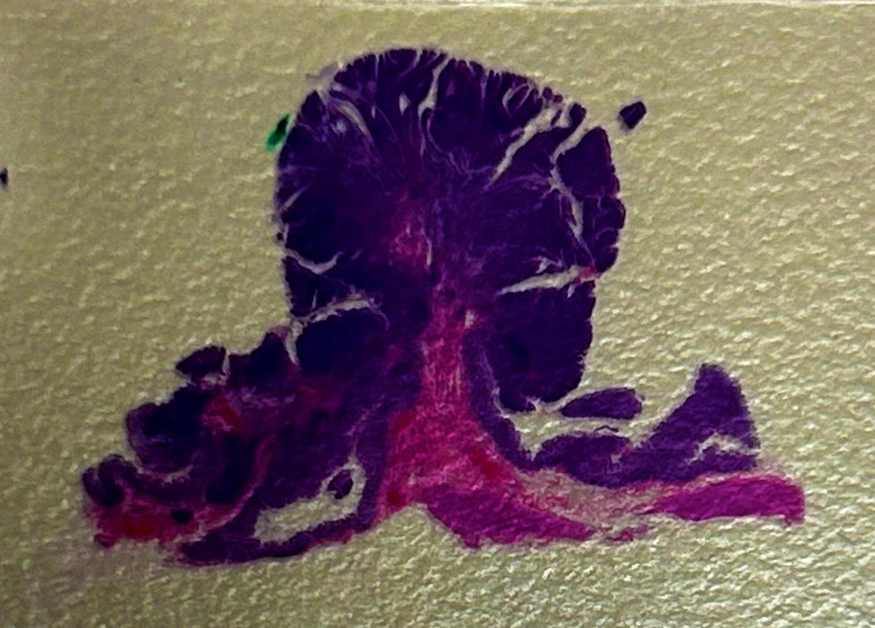 Path4People's tweet photo. FriYAY! ๐๐ฅณ
This #casestudyfriday features a routine colonoscopy of a 60-year-old woman where a 1.5 cm polyp was found. Her mom had colon cancer at 72.
#path4people
Answer: https://t.co/qzAMp5LXFL https://t.co/eZOqTQqRmj