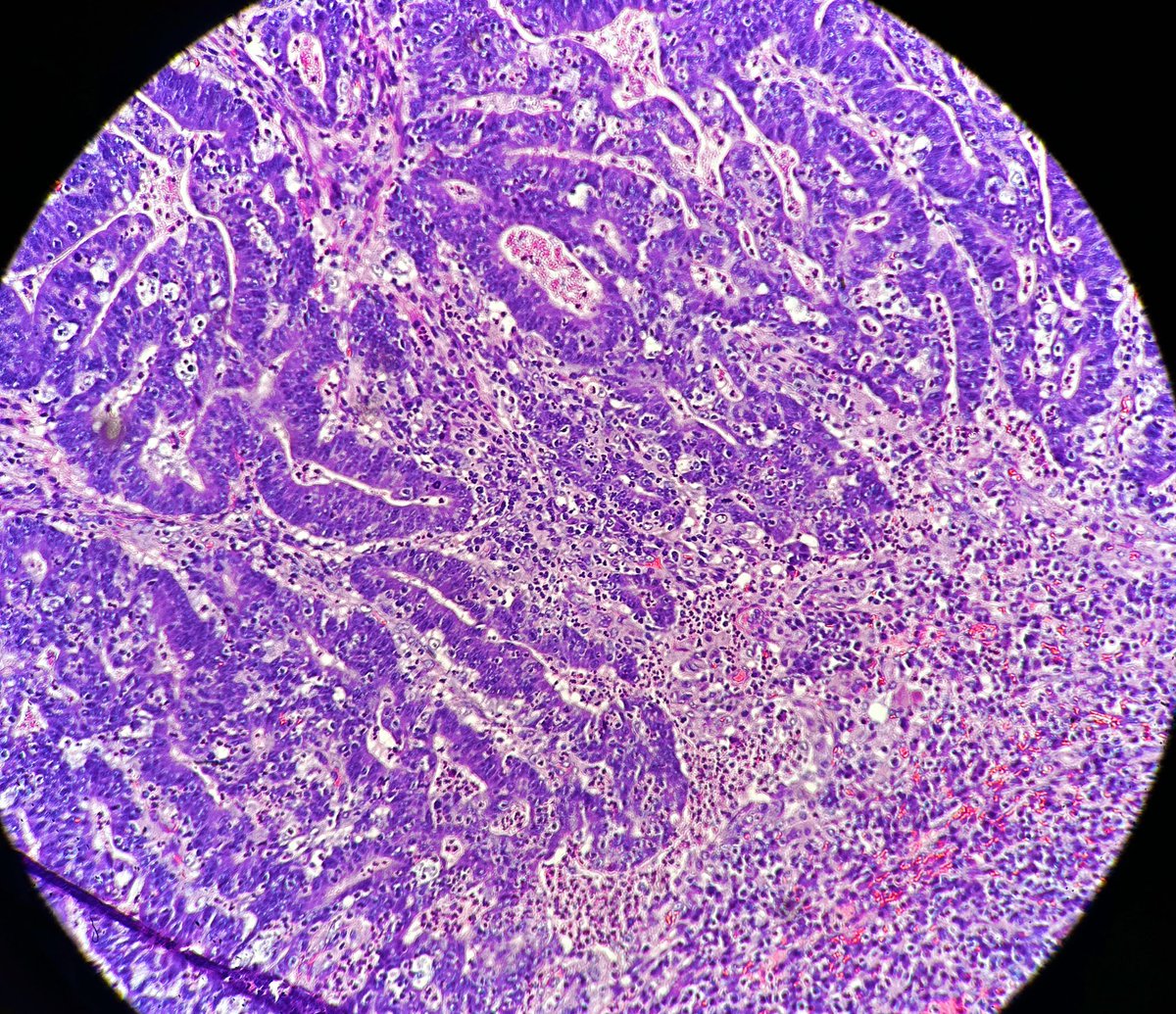 Path4People's tweet photo. FriYAY! ๐๐ฅณ
This #casestudyfriday features a routine colonoscopy of a 60-year-old woman where a 1.5 cm polyp was found. Her mom had colon cancer at 72.
#path4people
Answer: https://t.co/qzAMp5LXFL https://t.co/eZOqTQqRmj