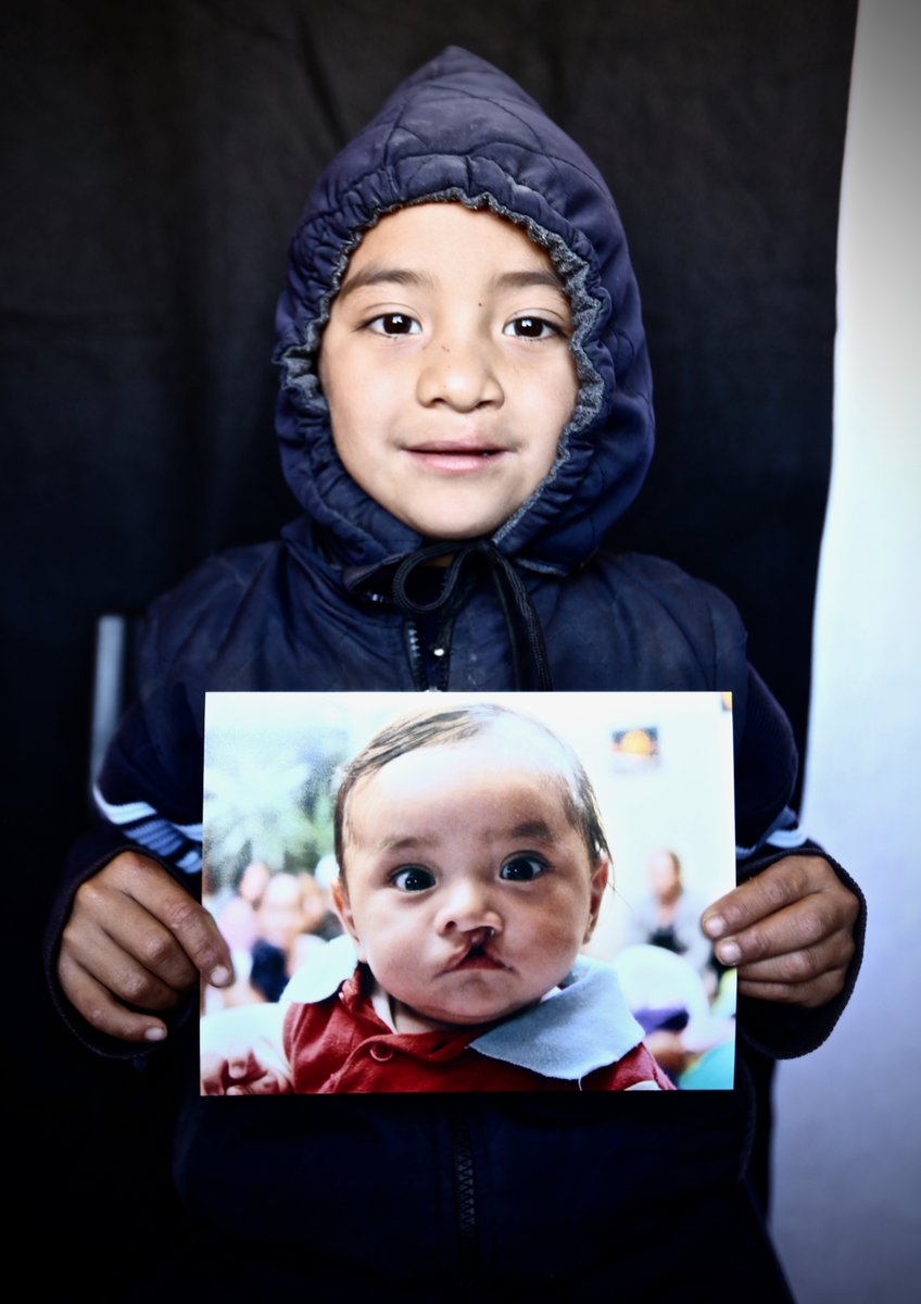 TessUnlimited's tweet photo. Ossiel and his amazing transformation!

#tessunlimited #cleftlipandpalate #everysmilehasastory https://t.co/SEtrCJE9Vv