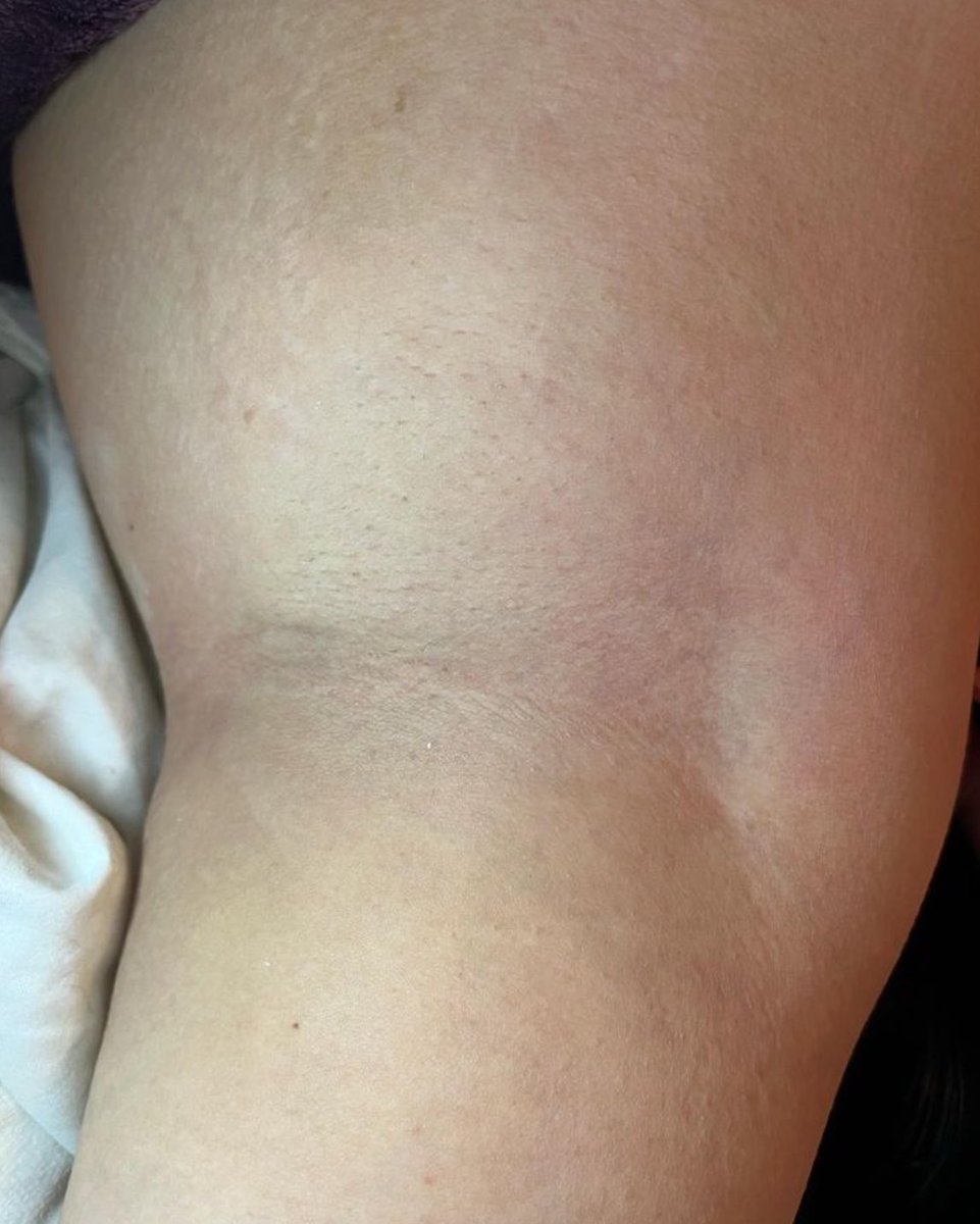 skinwithdaisy's tweet photo. easy and painless underarm waxing ! 😍 this was my first time doing an underarm wax. #stopshavingstartwaxing https://t.co/76gWSCtbD0